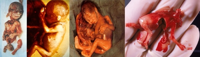 Avortement : ce que l’on ne vous dit pas. Des femmes témoignent